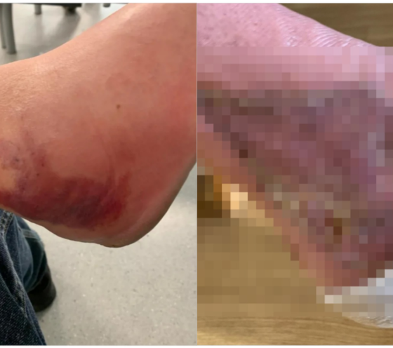 Mulher contrai 'bactéria comedora de carne' após machucar o tornozelo no jardim de casa