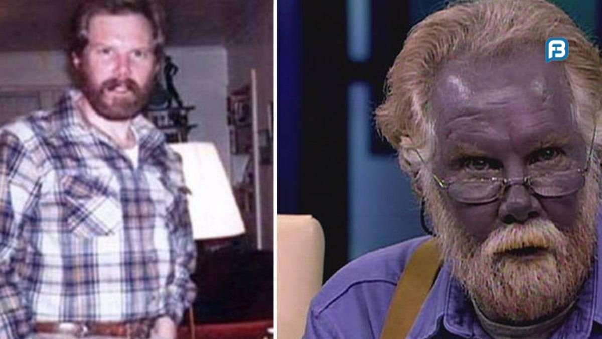 O homem que ficou azul: como a ciência explica o caso do 'Papai Smurf'