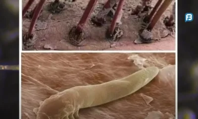 Descubra como o ácaro Demodex pode estar afetando sua pele. Saiba o que ele causa, como prevenir sua proliferação e evitar complicações.